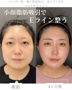 小顔脂肪吸引
