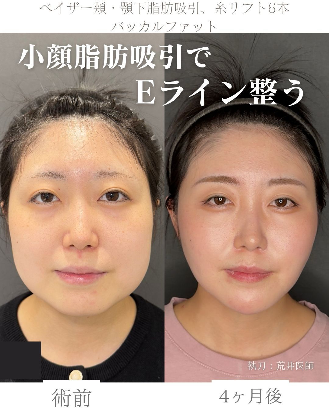 小顔脂肪吸引