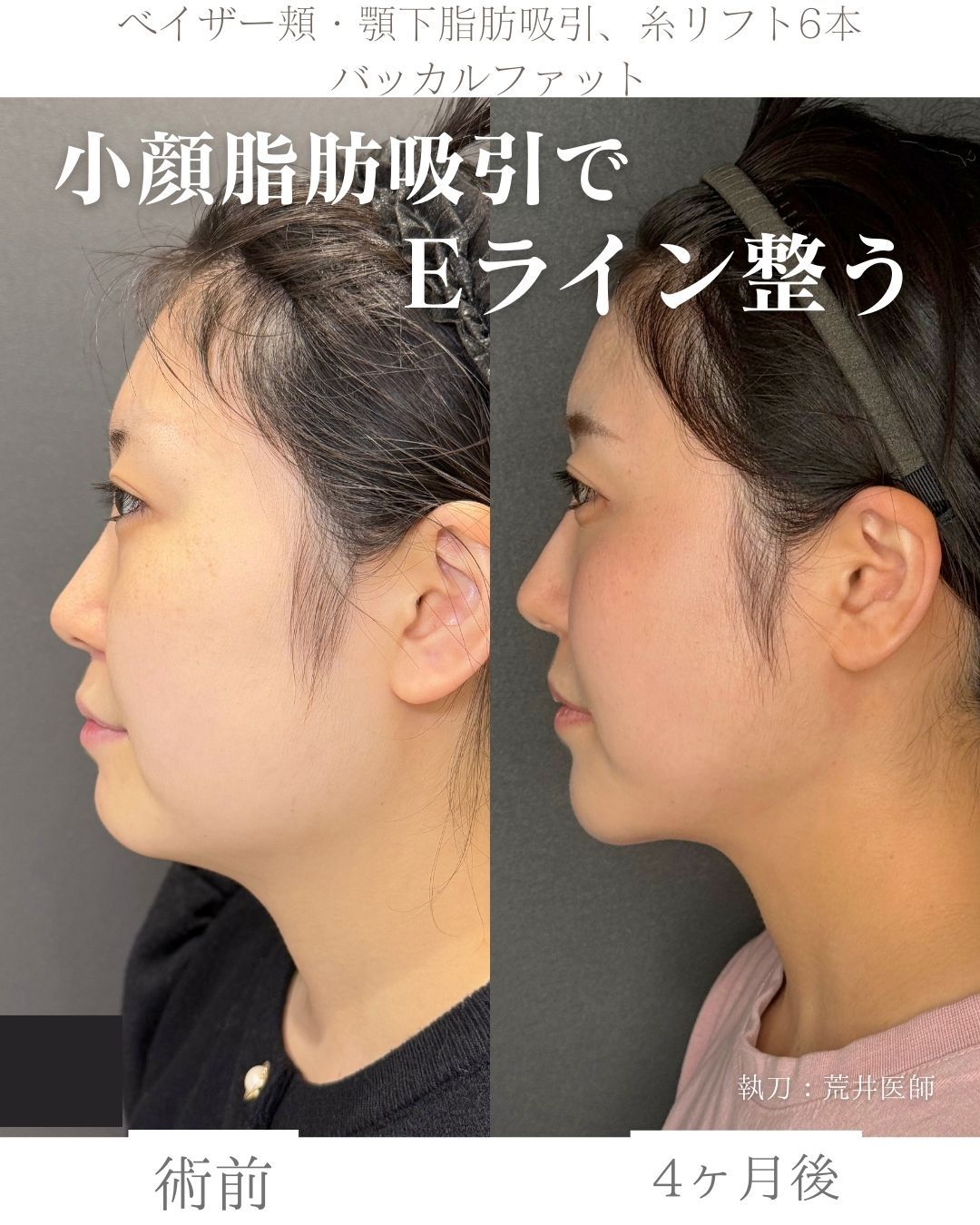 ベイザー小顔脂肪吸引