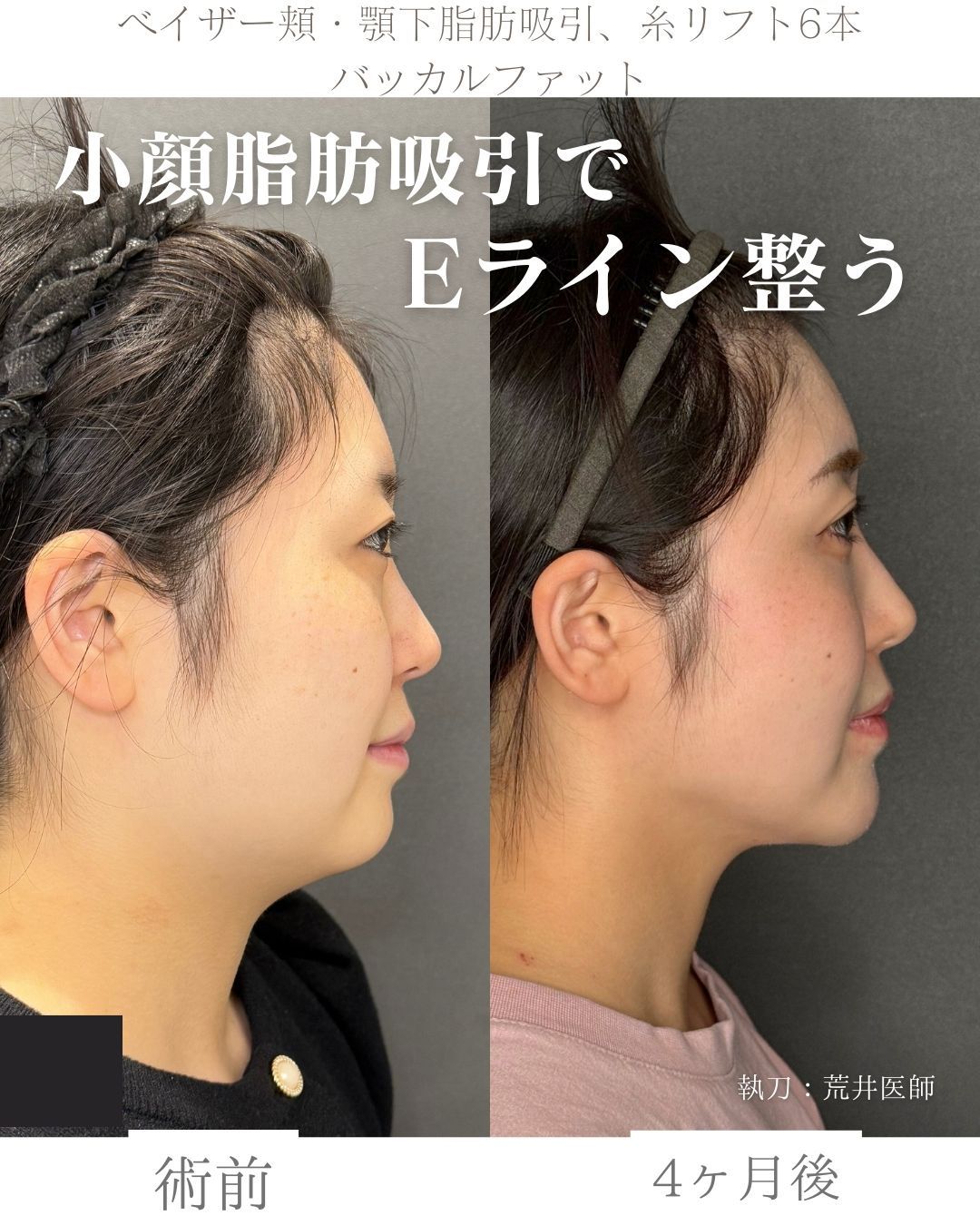 小顔脂肪吸引