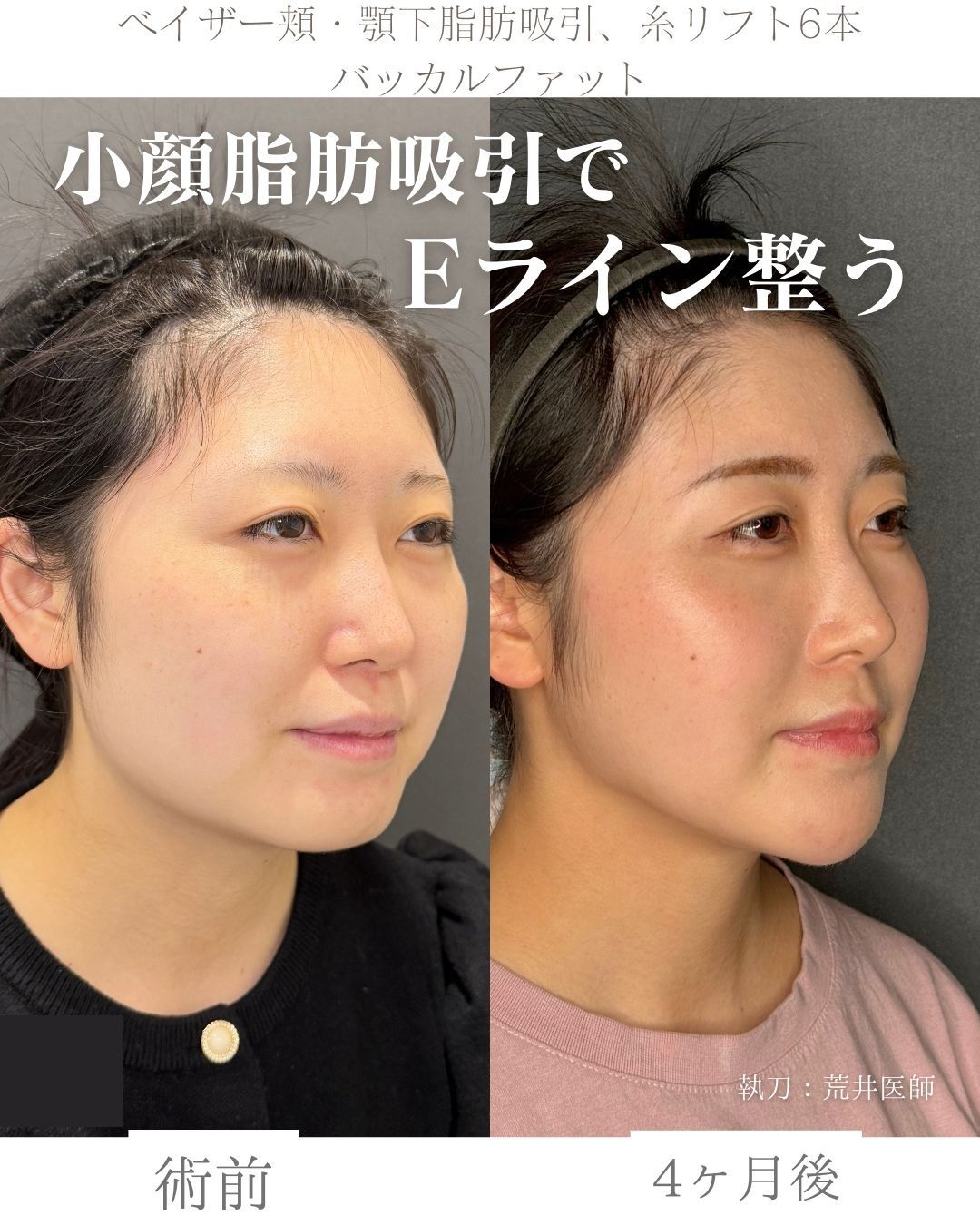 小顔脂肪吸引