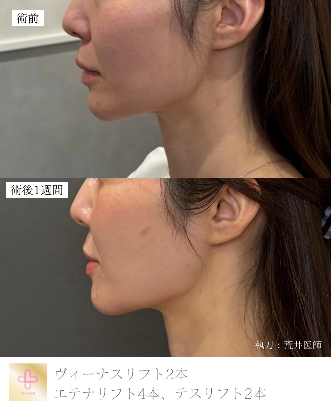 ヴィーナスリフト2本、エテナリフト4本、テスリフト2本