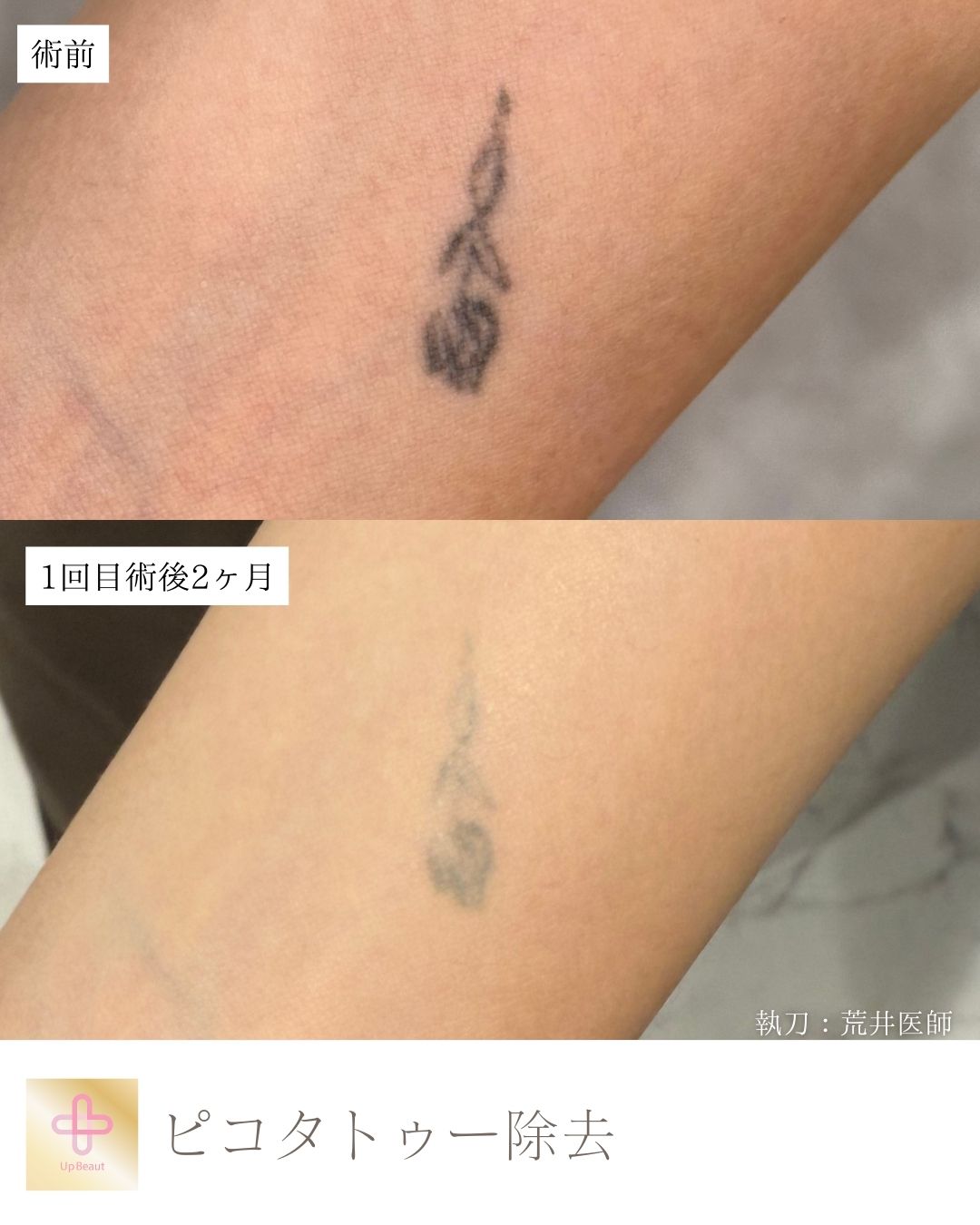 ピコタトゥー除去