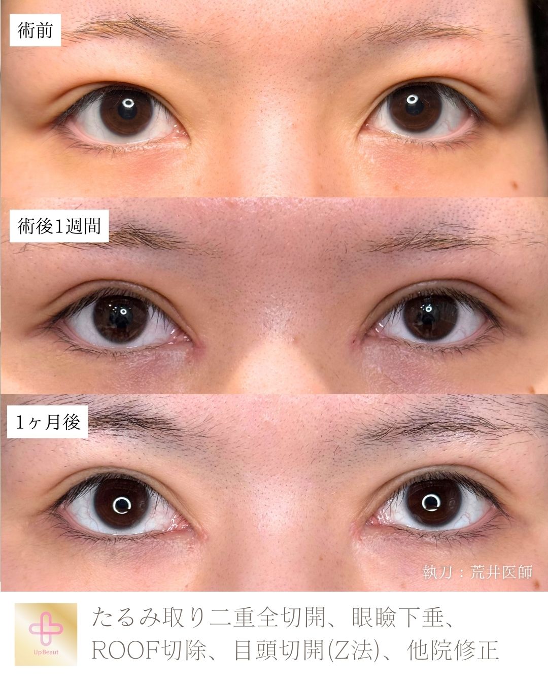 たるみ取り併用全切開二重術、目頭切開(Z法) 、眼瞼下垂、ROOF切除、他院修正