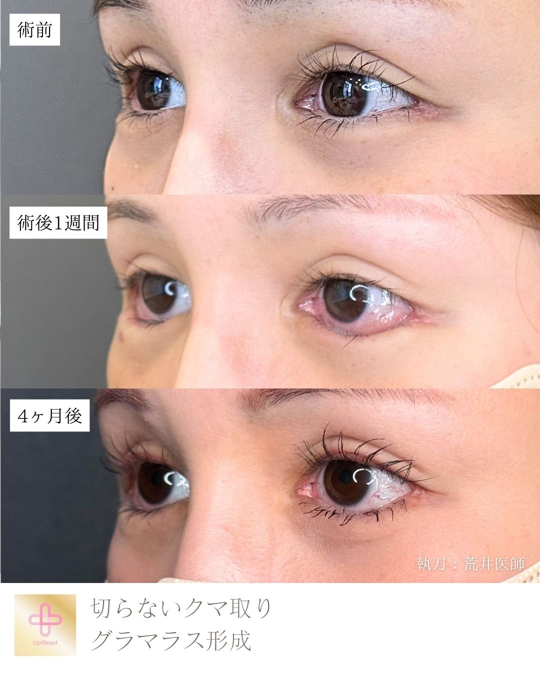 アーモンドアイ形成、切らないクマ取り