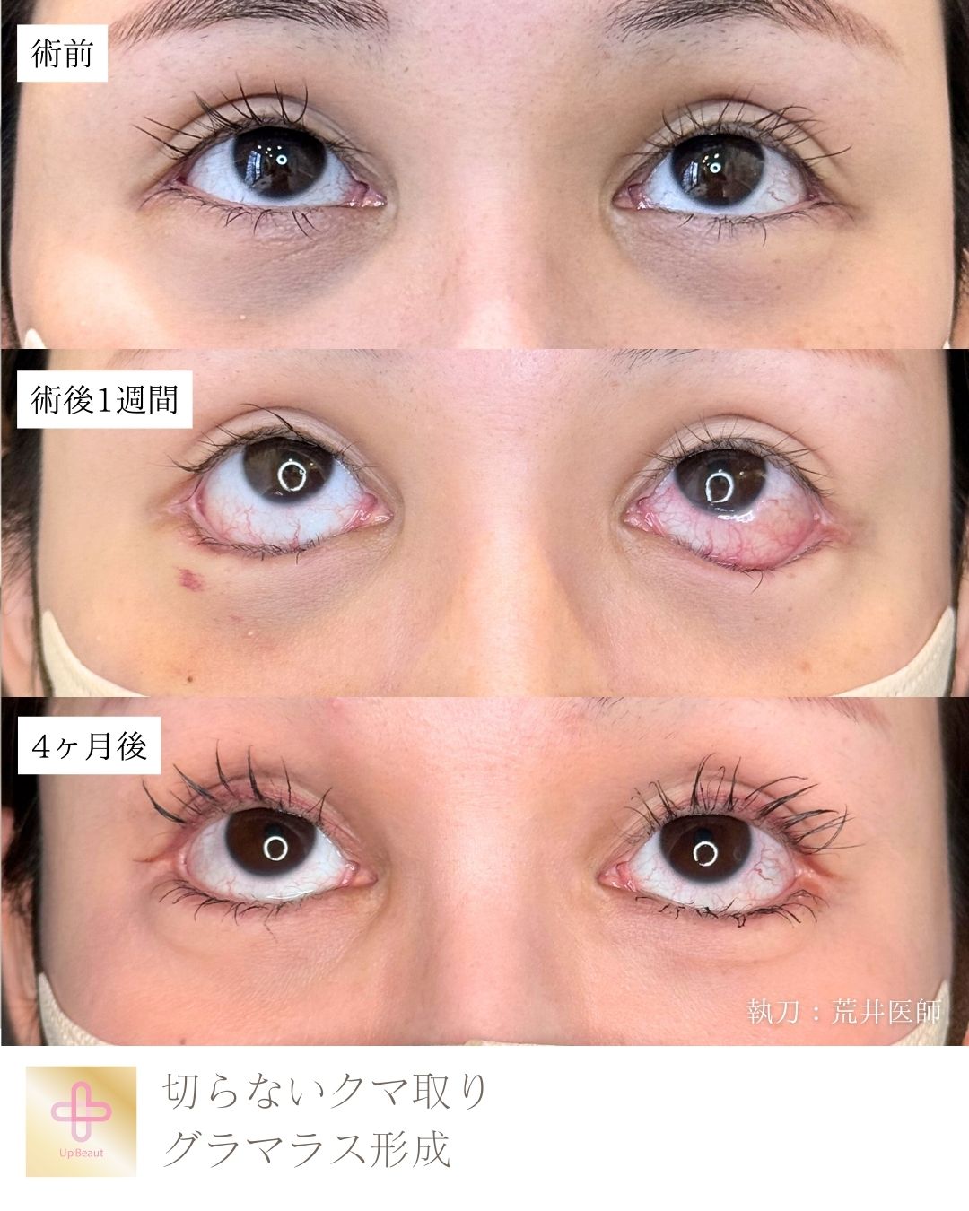 アーモンドアイ形成、切らないクマ取り