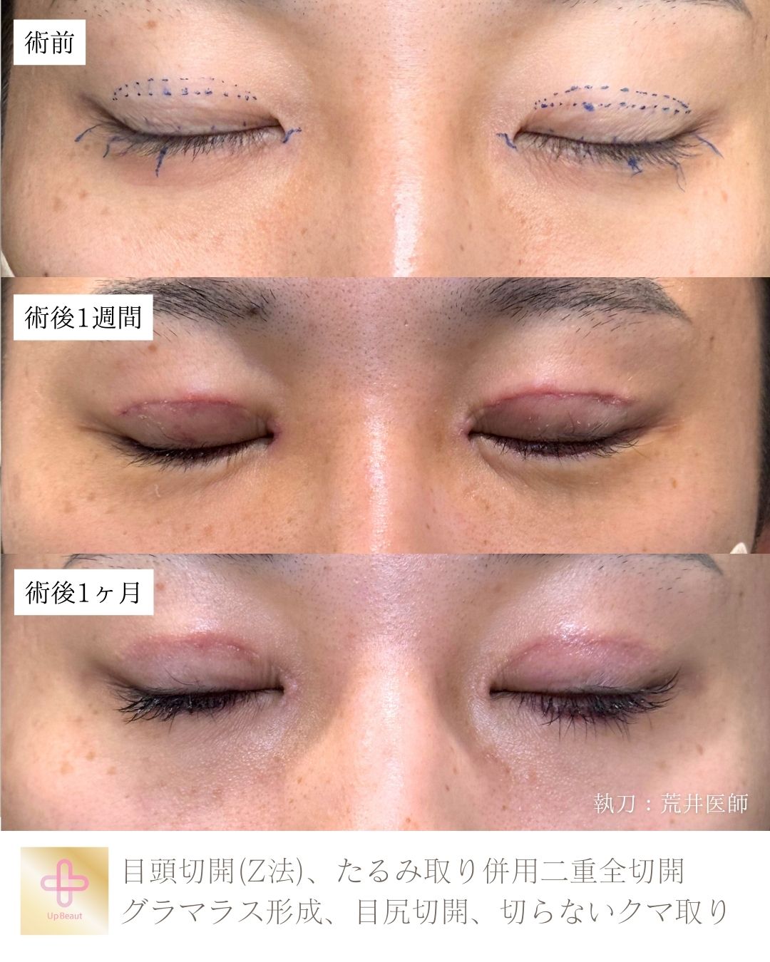 目頭切開,たるみ取り併用二重全切開、グラマラス形成、目尻切開、切らないクマ取り