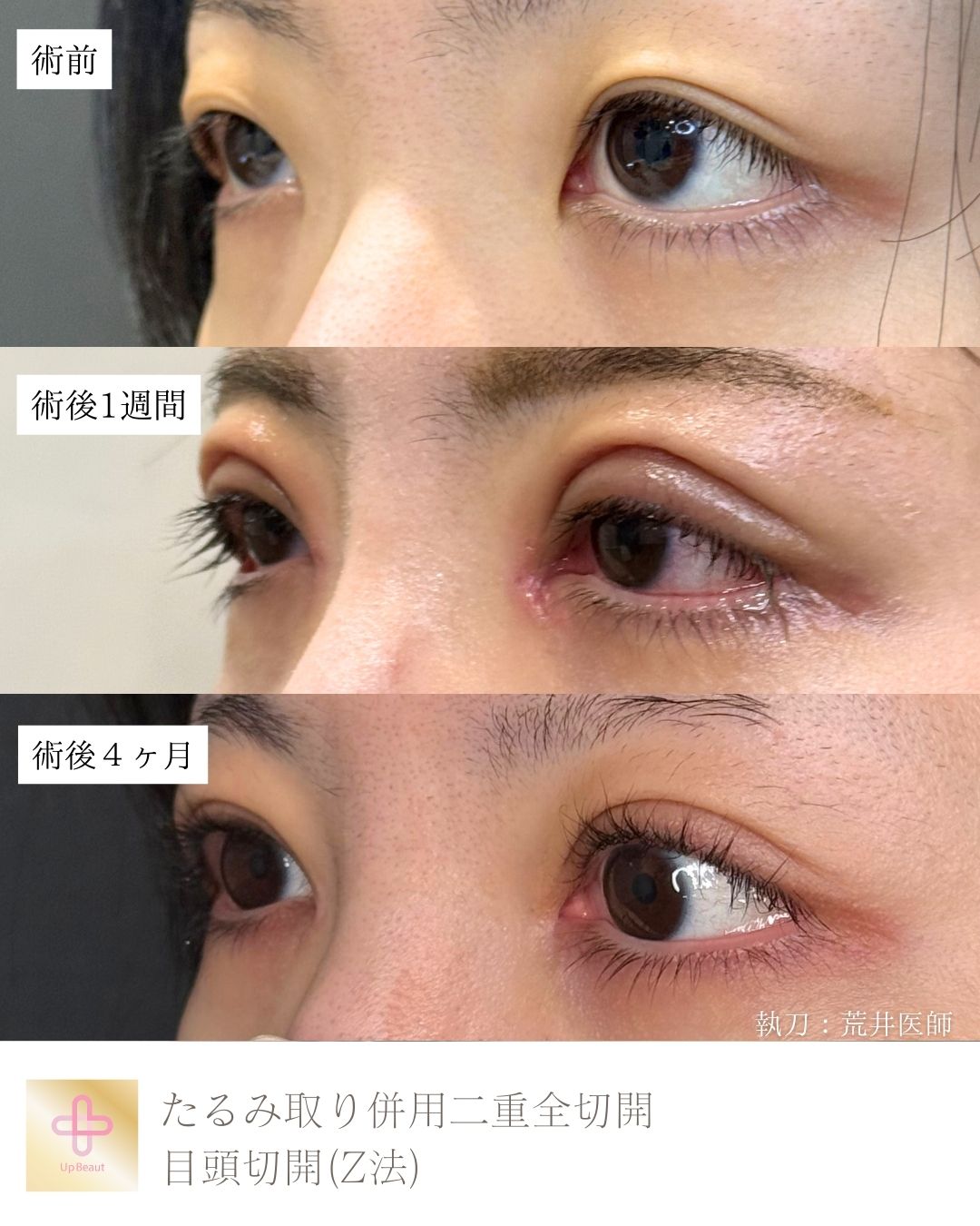 たるみ取り併用二重全切開、