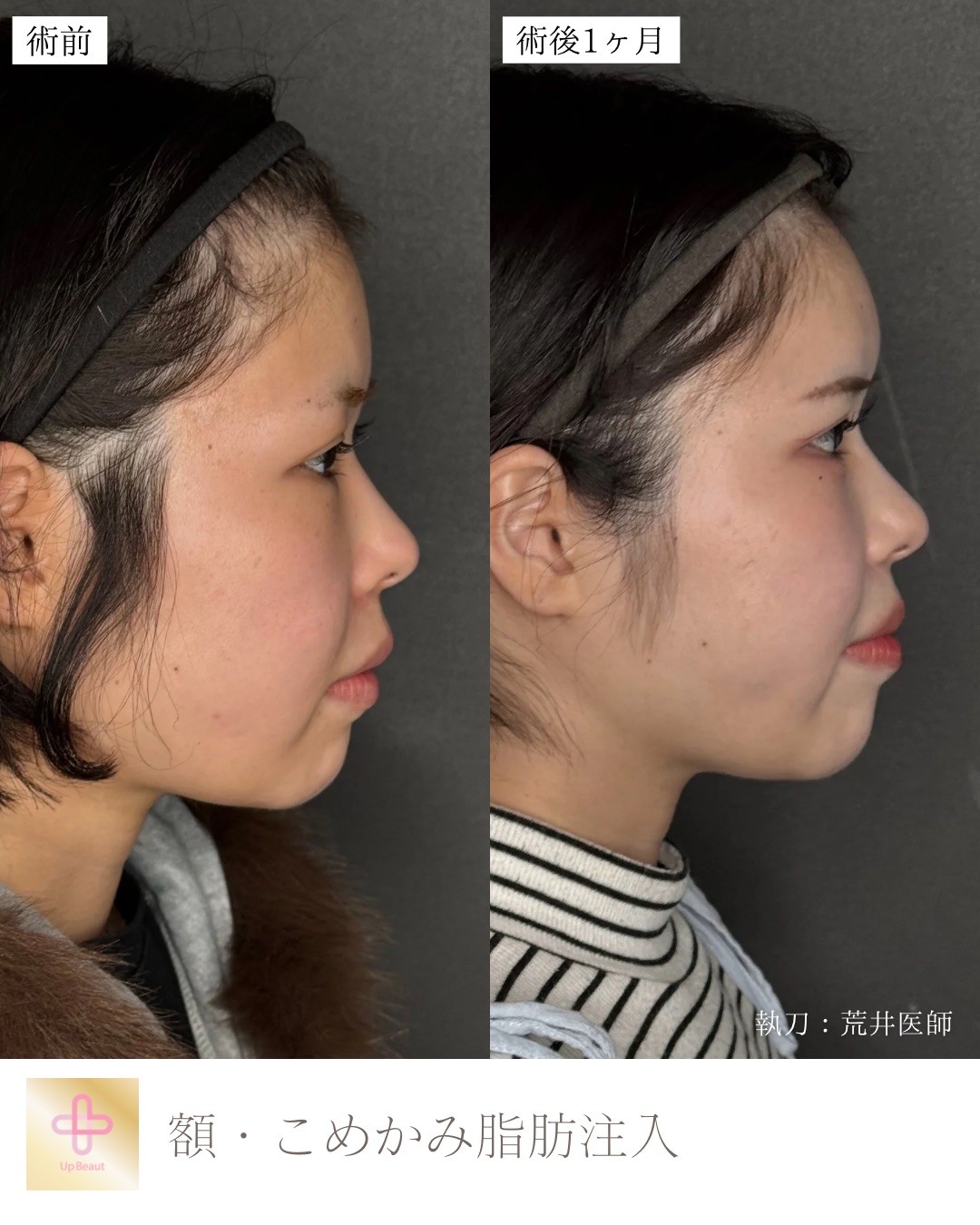 脂肪注入　額 ・こめかみ