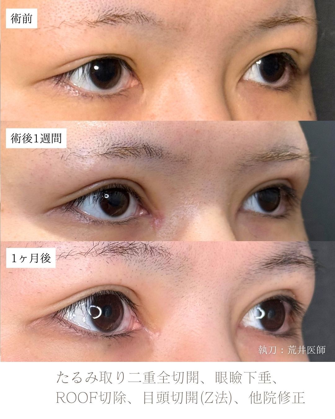 たるみ取り併用二重全切開