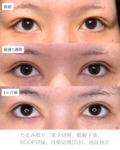 たるみ取り併用二重全切開症例