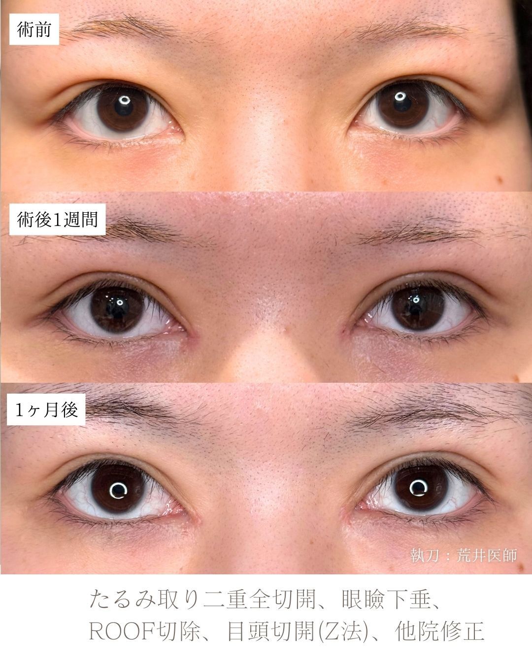 たるみ取り併用二重全切開症例