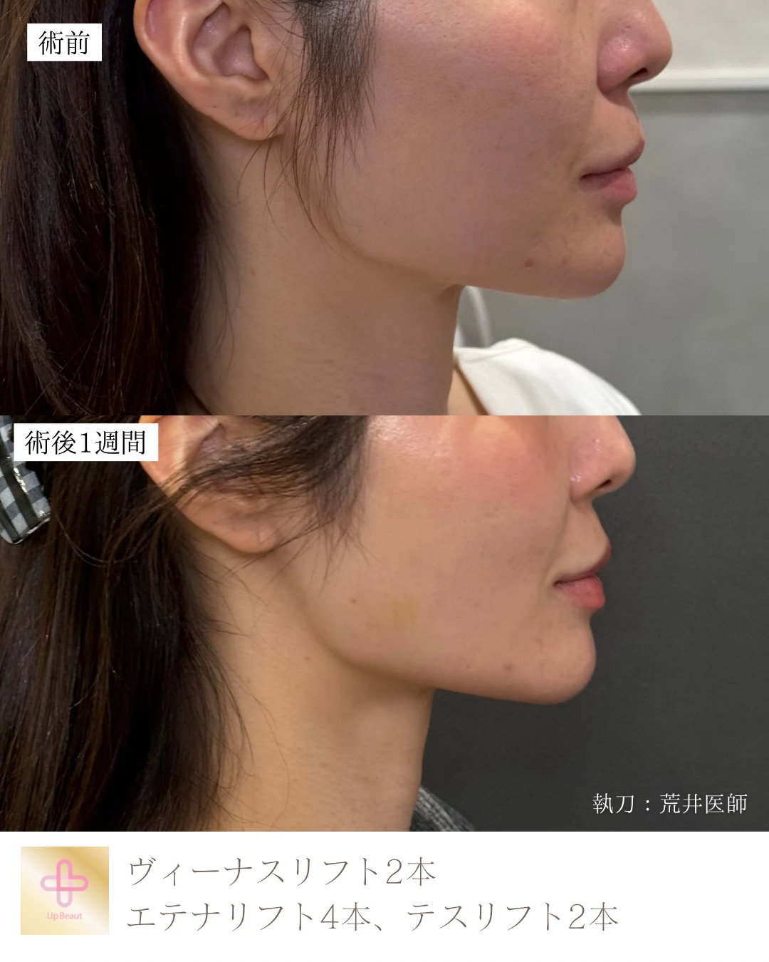 ヴィーナスリフト2本、エテナリフト4本、テスリフト2本