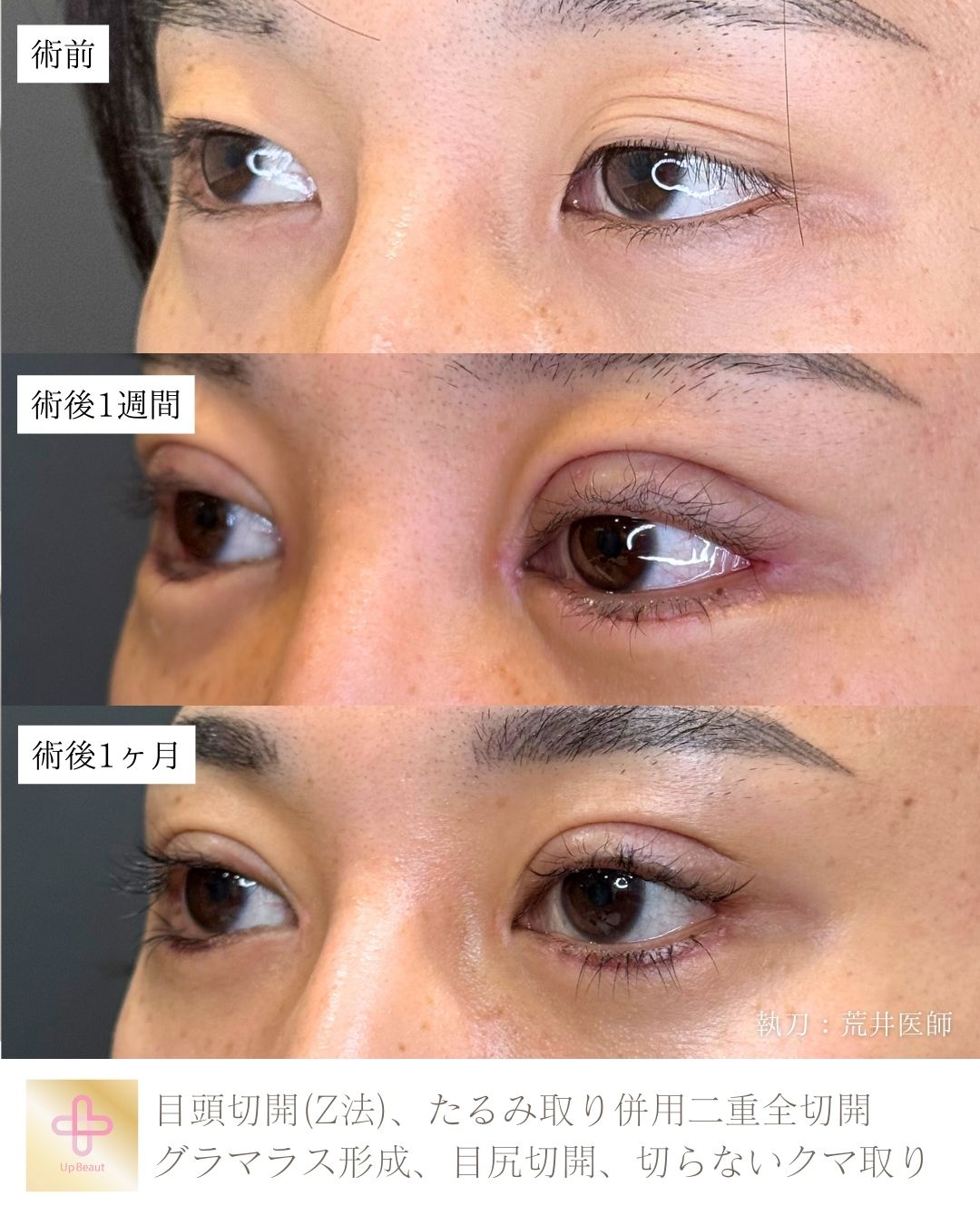 目頭切開,たるみ取り併用二重全切開、グラマラス形成、目尻切開、切らないクマ取り