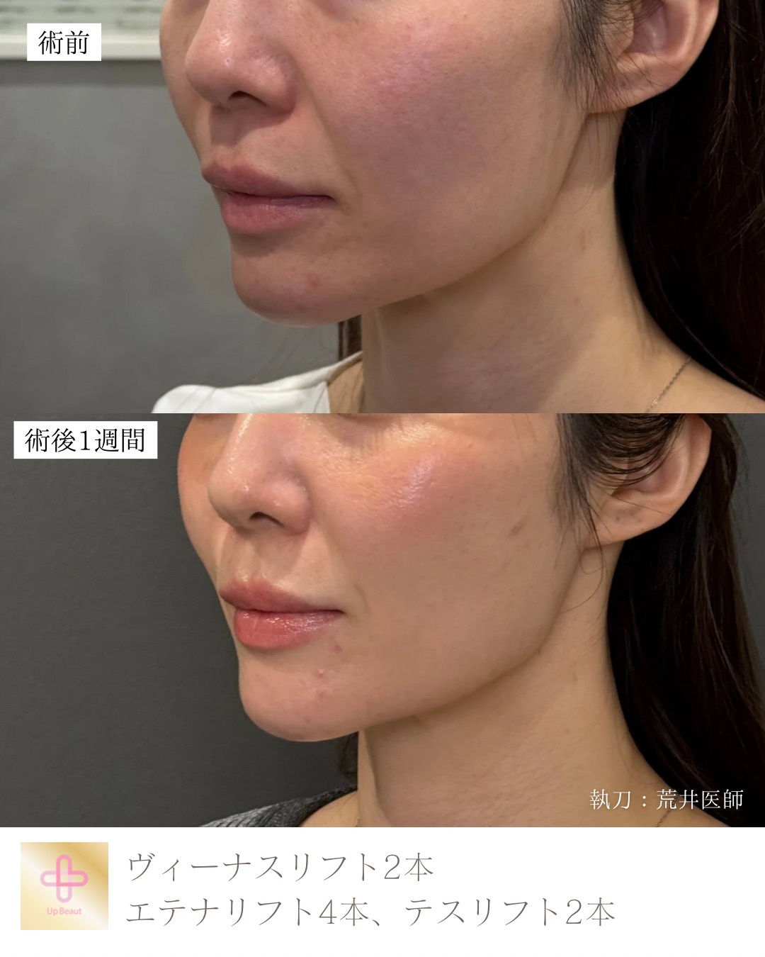 ヴィーナスリフト2本、エテナリフト4本、テスリフト2本