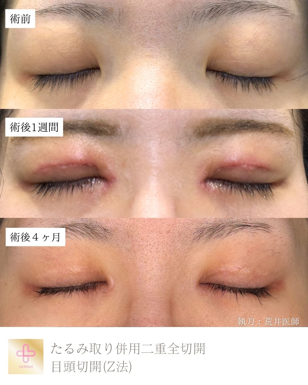 たるみ取り併用二重全切開、