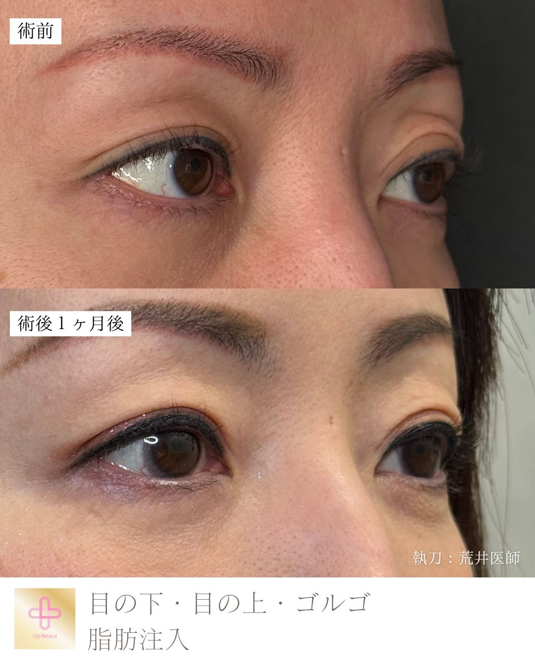脂肪注入（目の上、目の下）