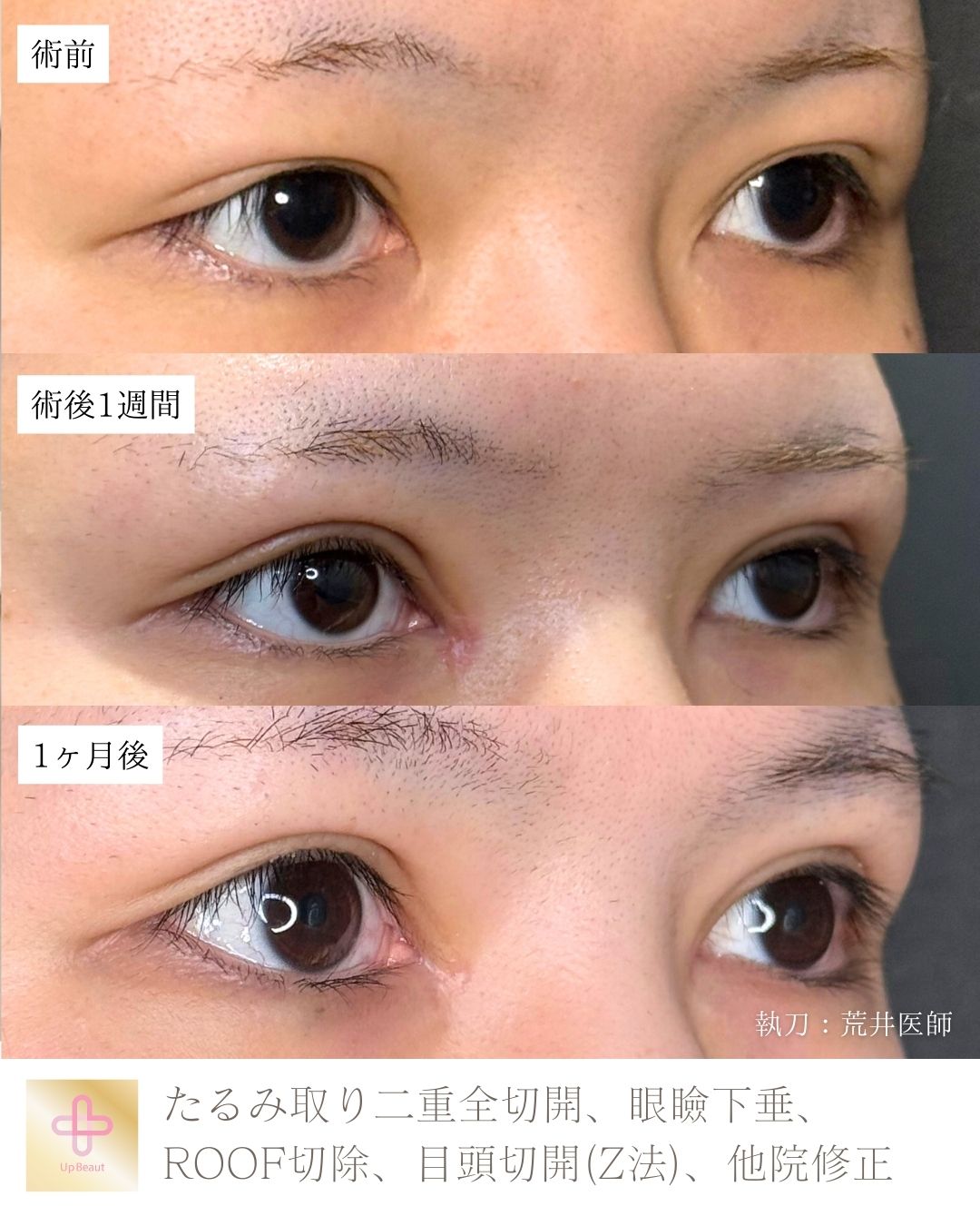 たるみ取り併用全切開二重術、目頭切開(Z法) 、眼瞼下垂、ROOF切除、他院修正