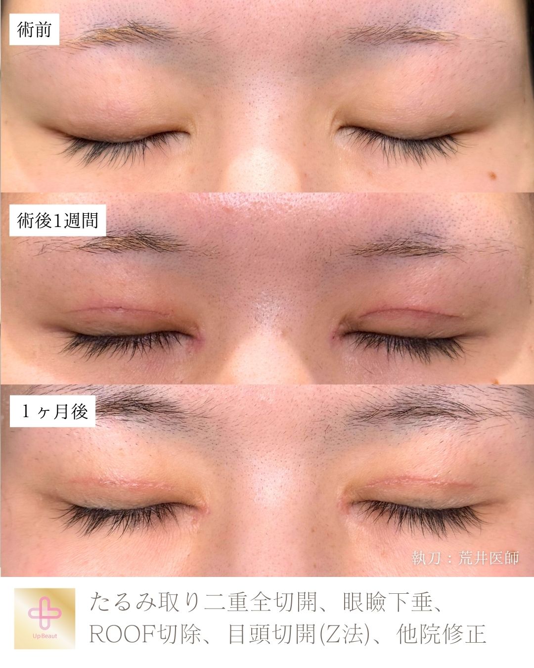 たるみ取り併用全切開二重術、目頭切開(Z法) 、眼瞼下垂、ROOF切除、他院修正