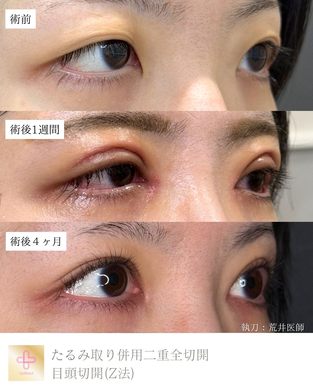 たるみ取り併用二重全切開、