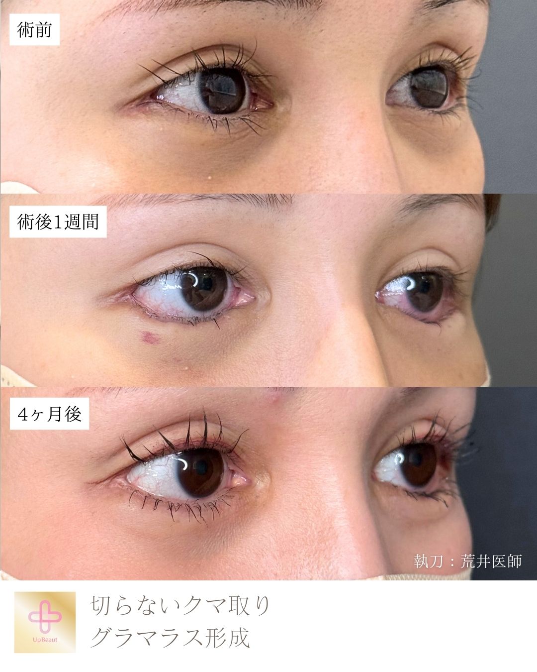 アーモンドアイ形成、切らないクマ取り