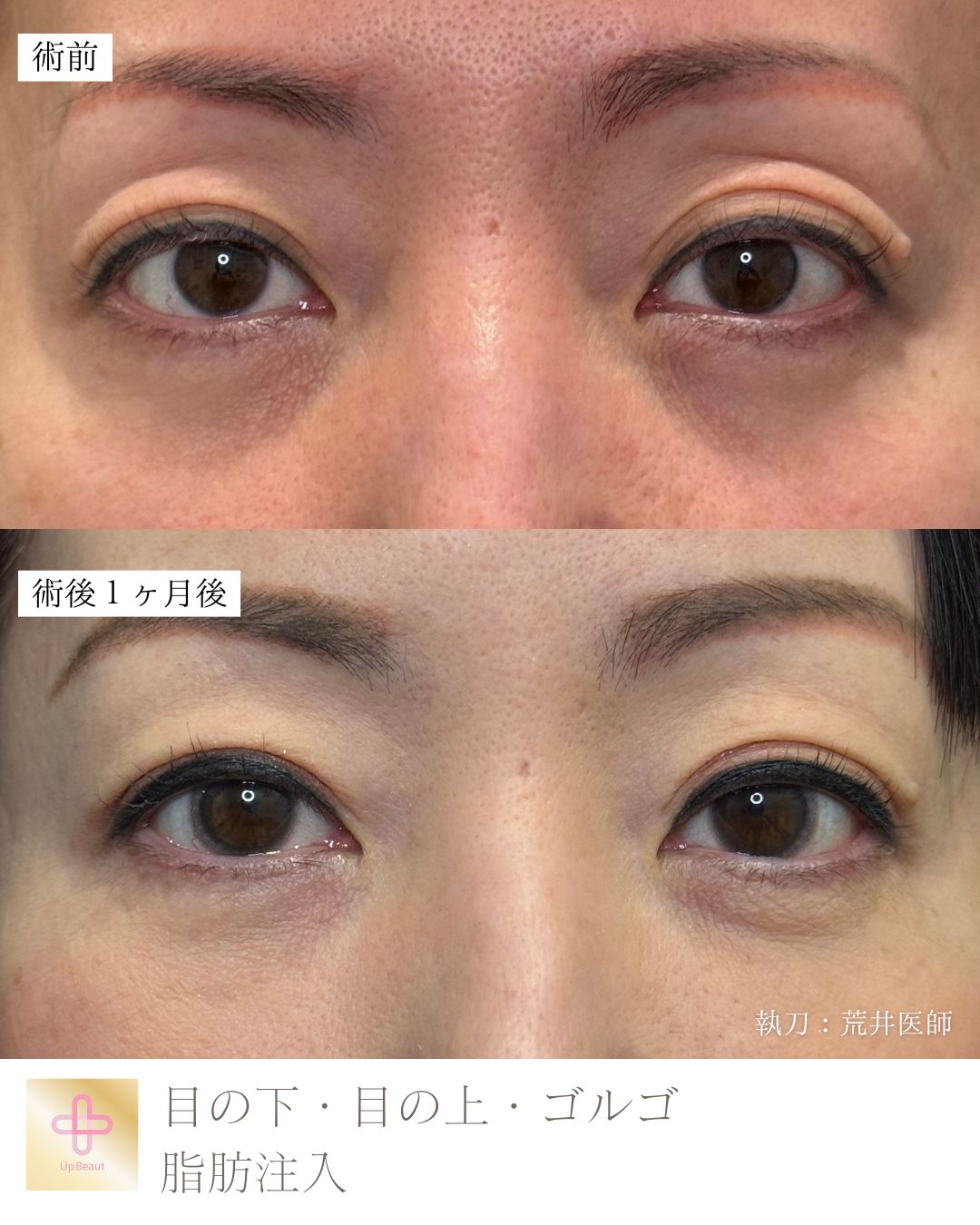 脂肪注入（目の上、目の下）