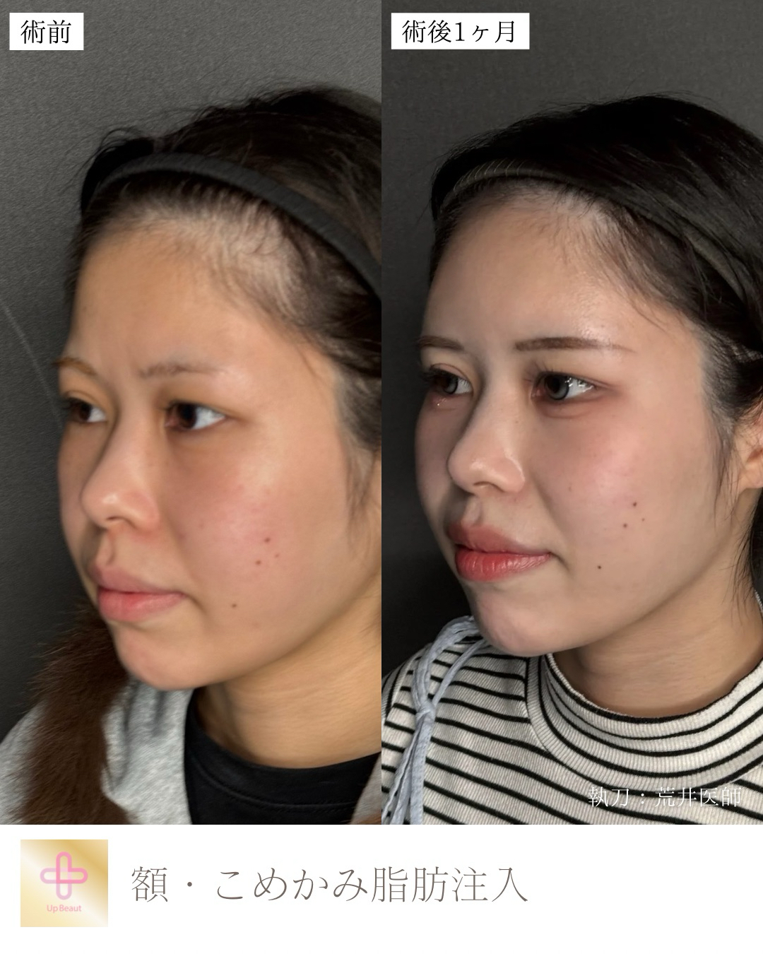 脂肪注入　額 ・こめかみ