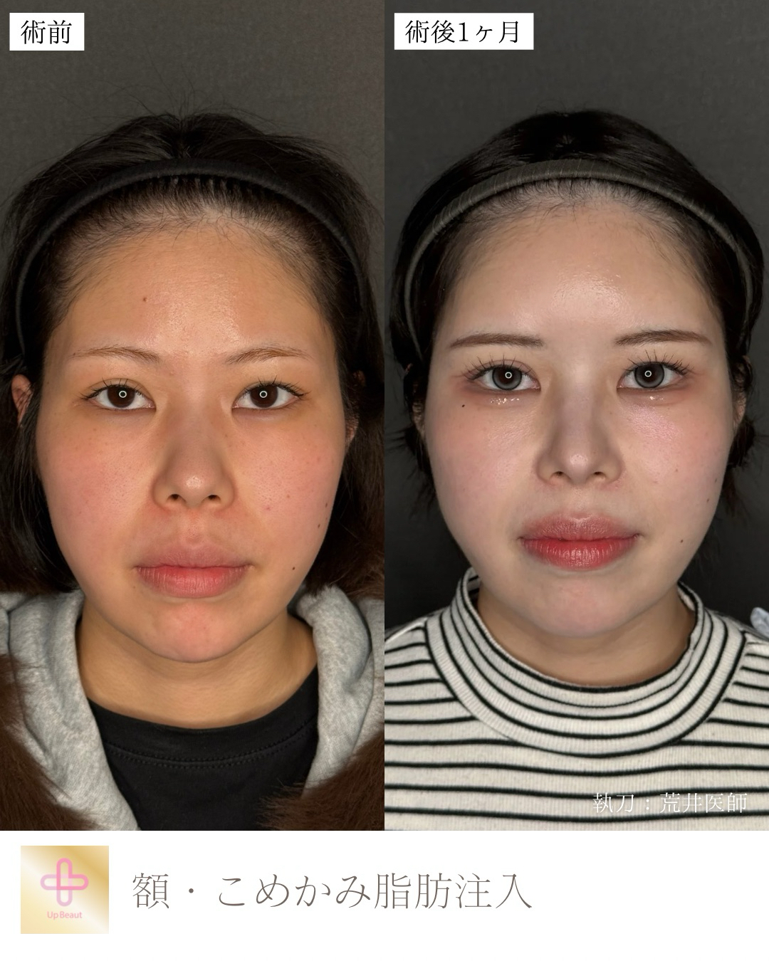 脂肪注入　額 ・こめかみ