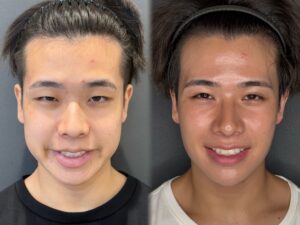 バッカルファット