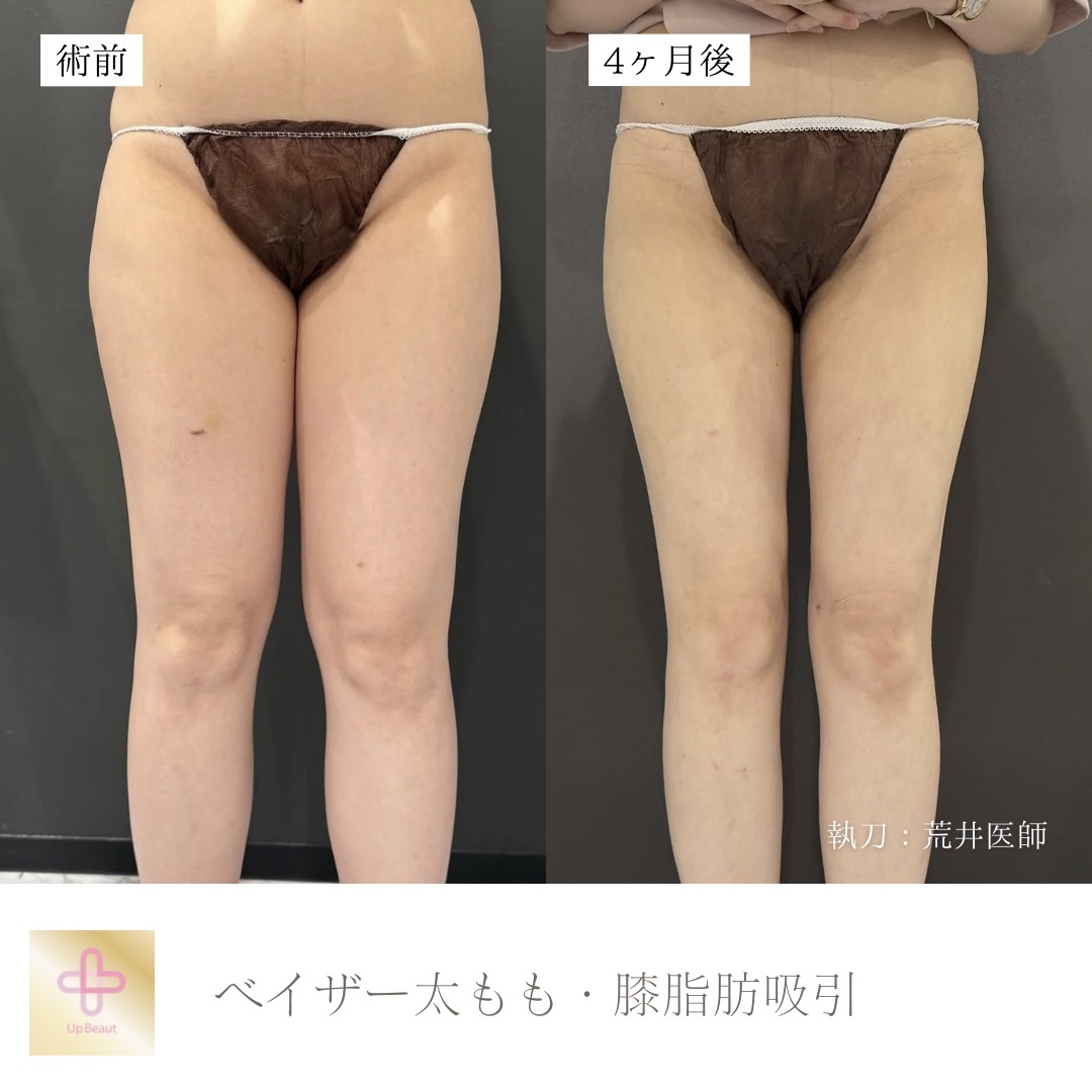 太もも全周・膝脂肪吸引