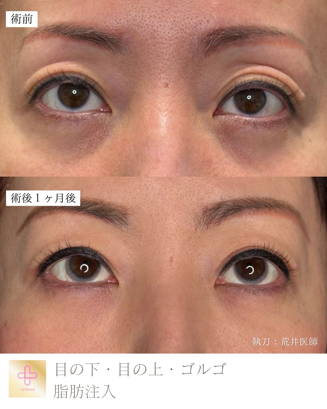 脂肪注入（目の上、目の下）