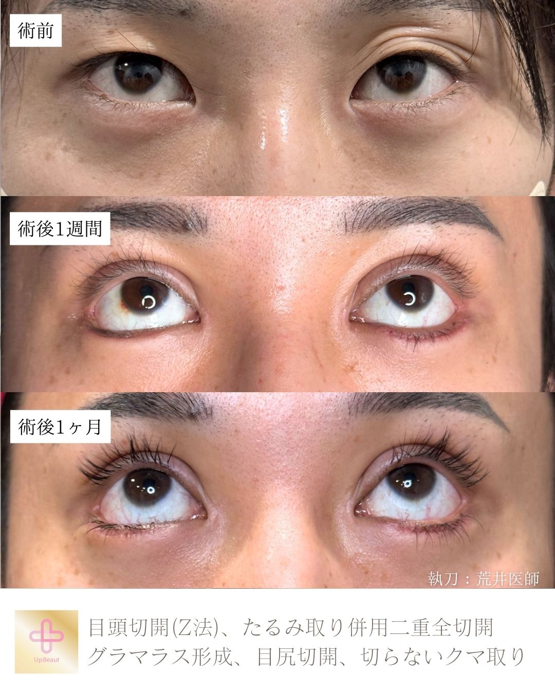 目頭切開,たるみ取り併用二重全切開、グラマラス形成、目尻切開、切らないクマ取り