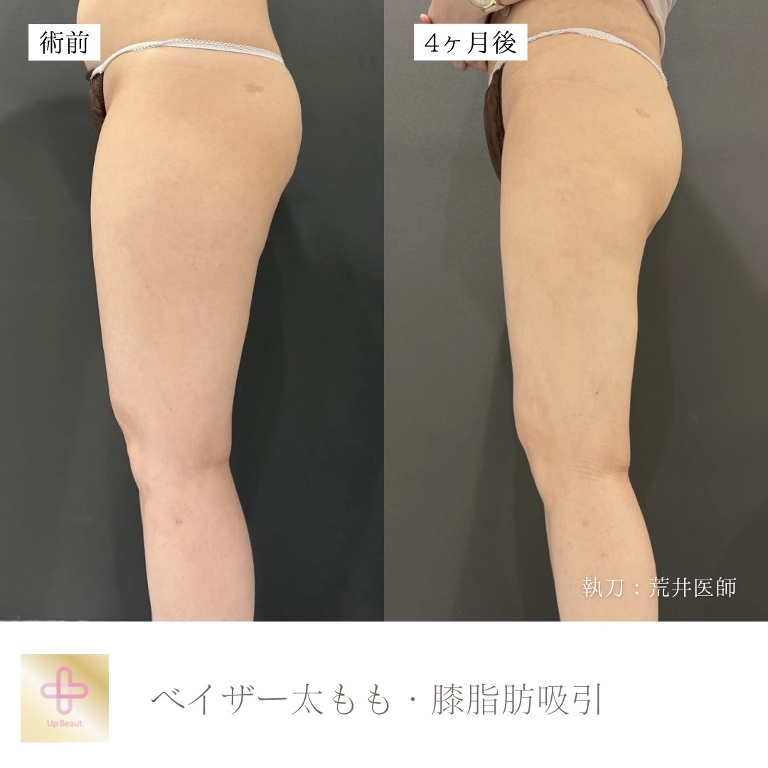 太もも全周・膝脂肪吸引
