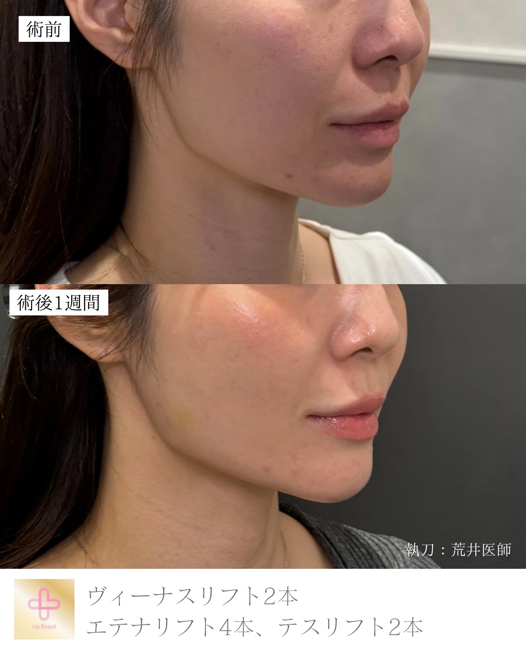 ヴィーナスリフト2本、エテナリフト4本、テスリフト2本