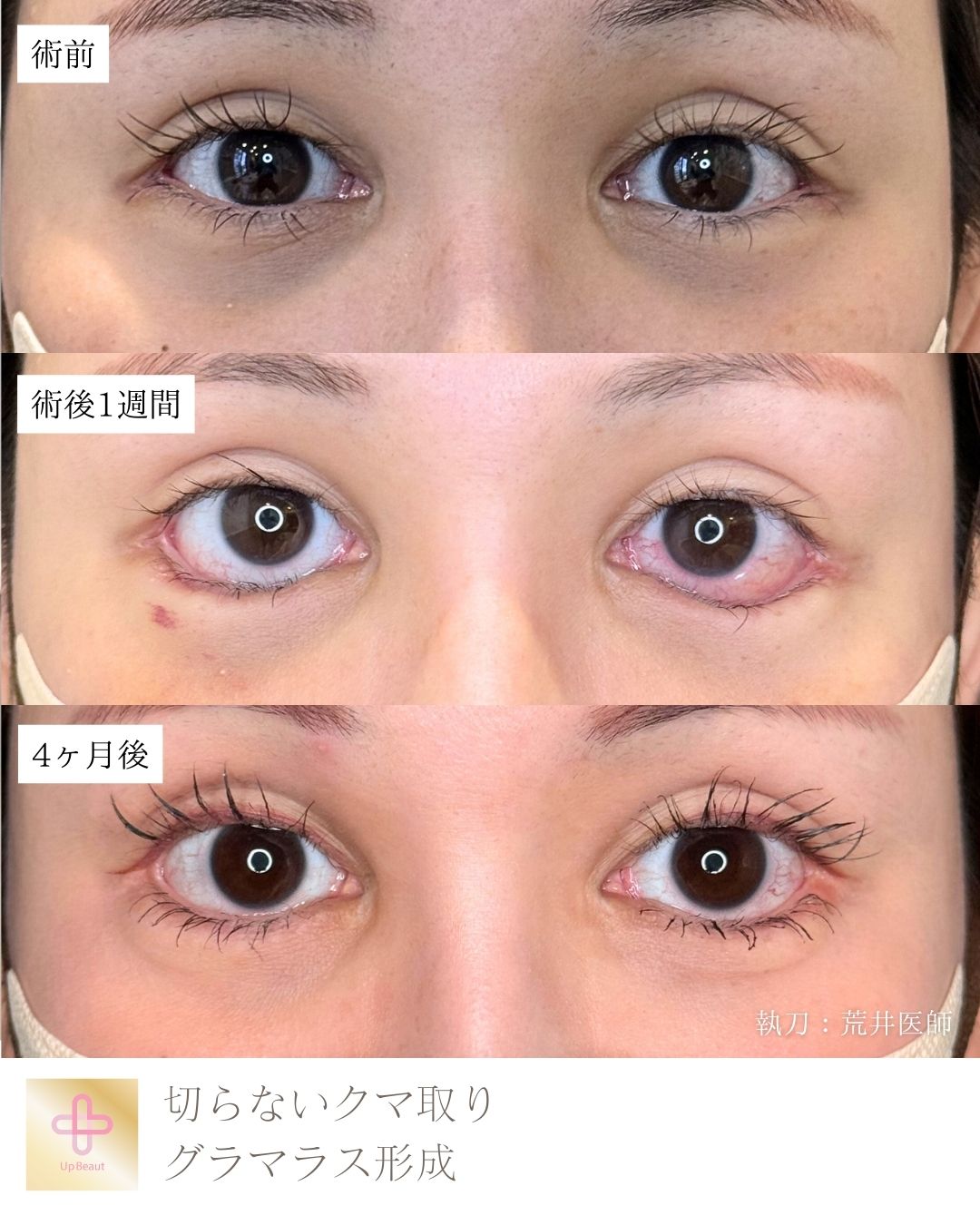 アーモンドアイ形成、切らないクマ取り