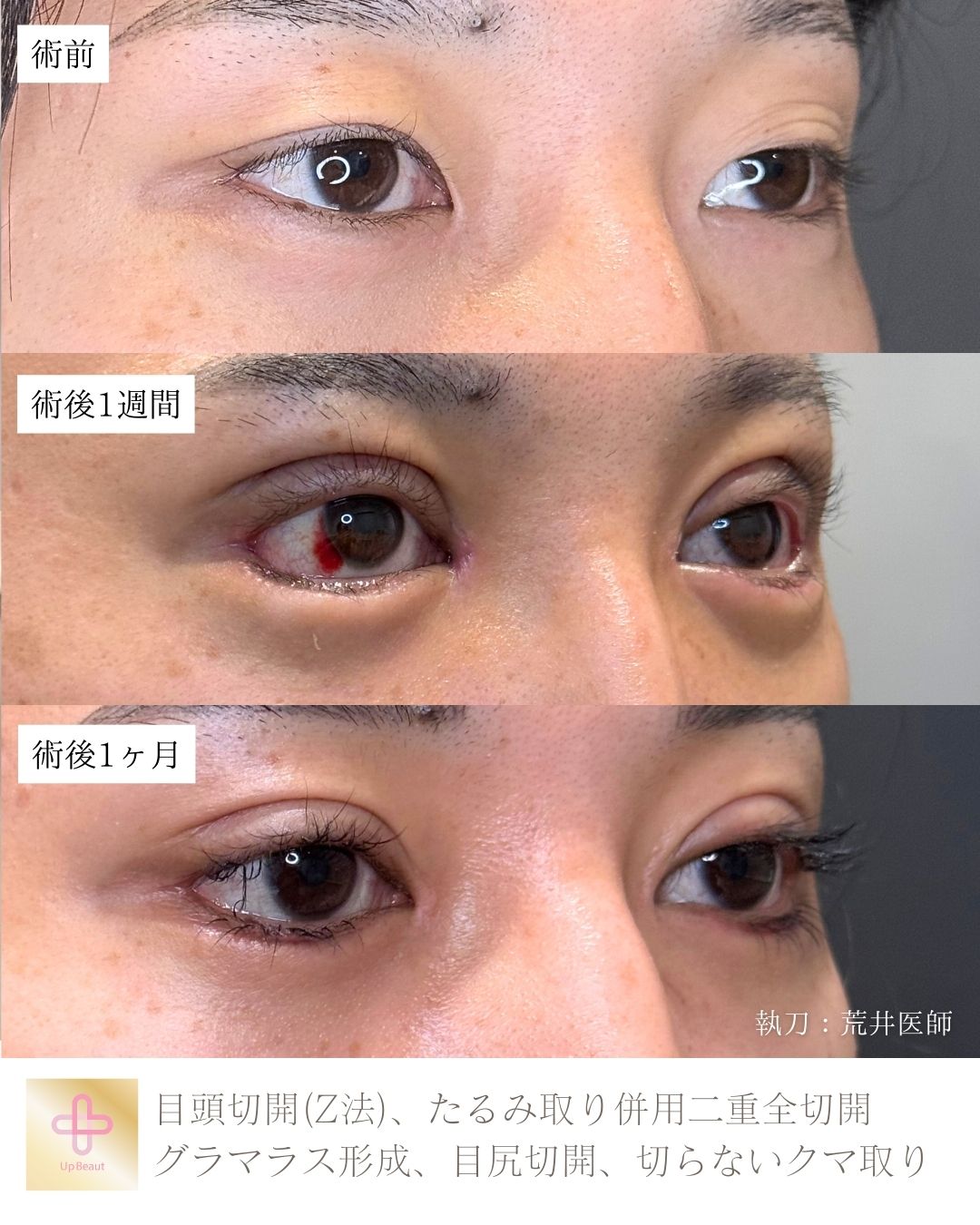 目頭切開,たるみ取り併用二重全切開、グラマラス形成、目尻切開、切らないクマ取り