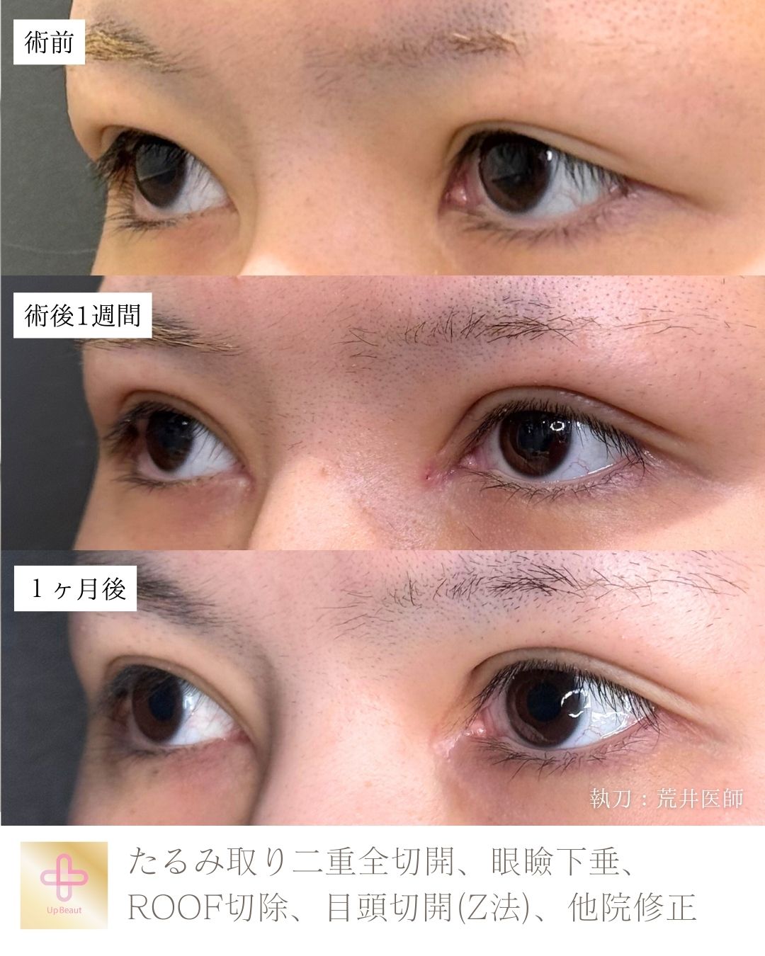 たるみ取り併用全切開二重術、目頭切開(Z法) 、眼瞼下垂、ROOF切除、他院修正