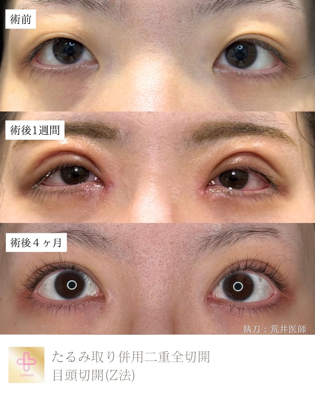 たるみ取り併用二重全切開、