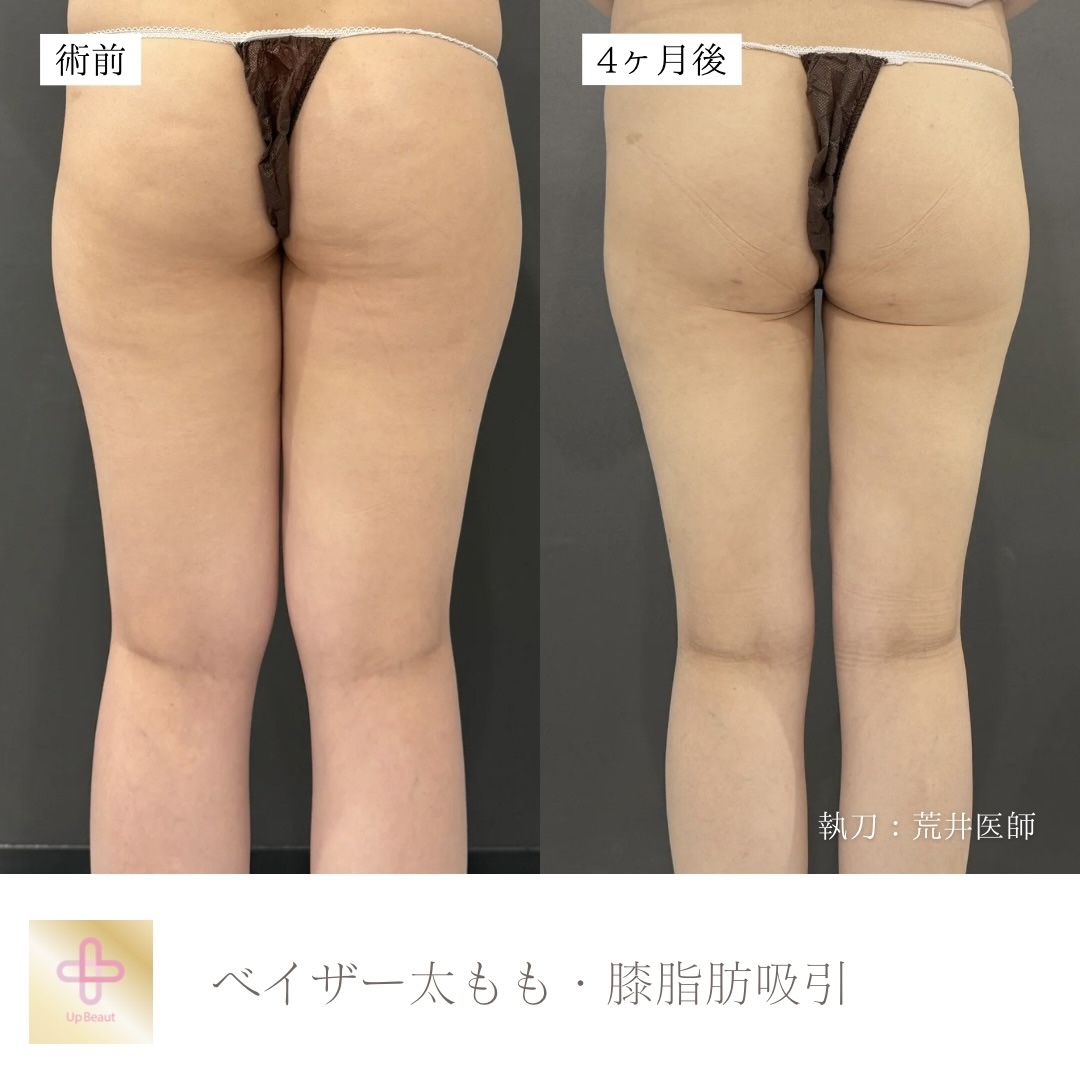 太もも全周・膝脂肪吸引