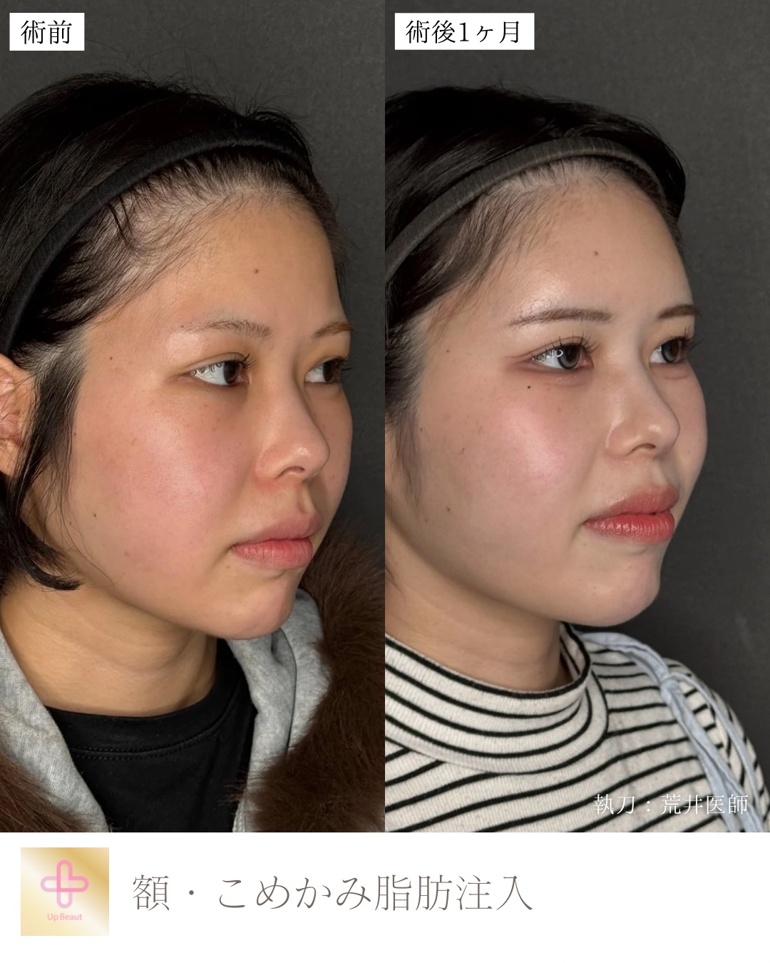 脂肪注入　額 ・こめかみ