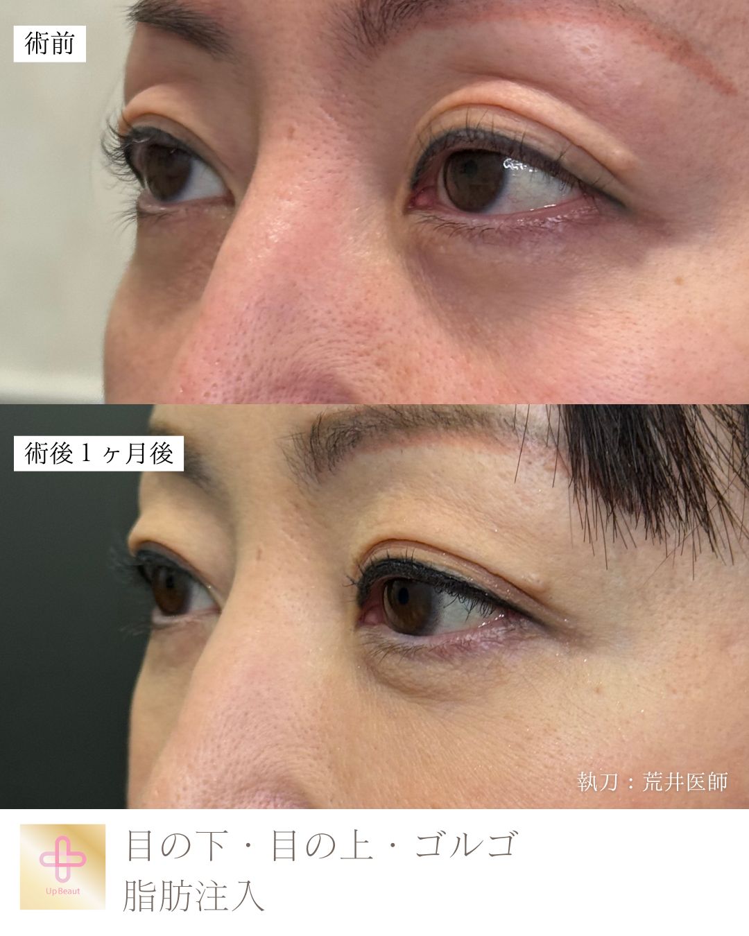 脂肪注入（目の上、目の下）