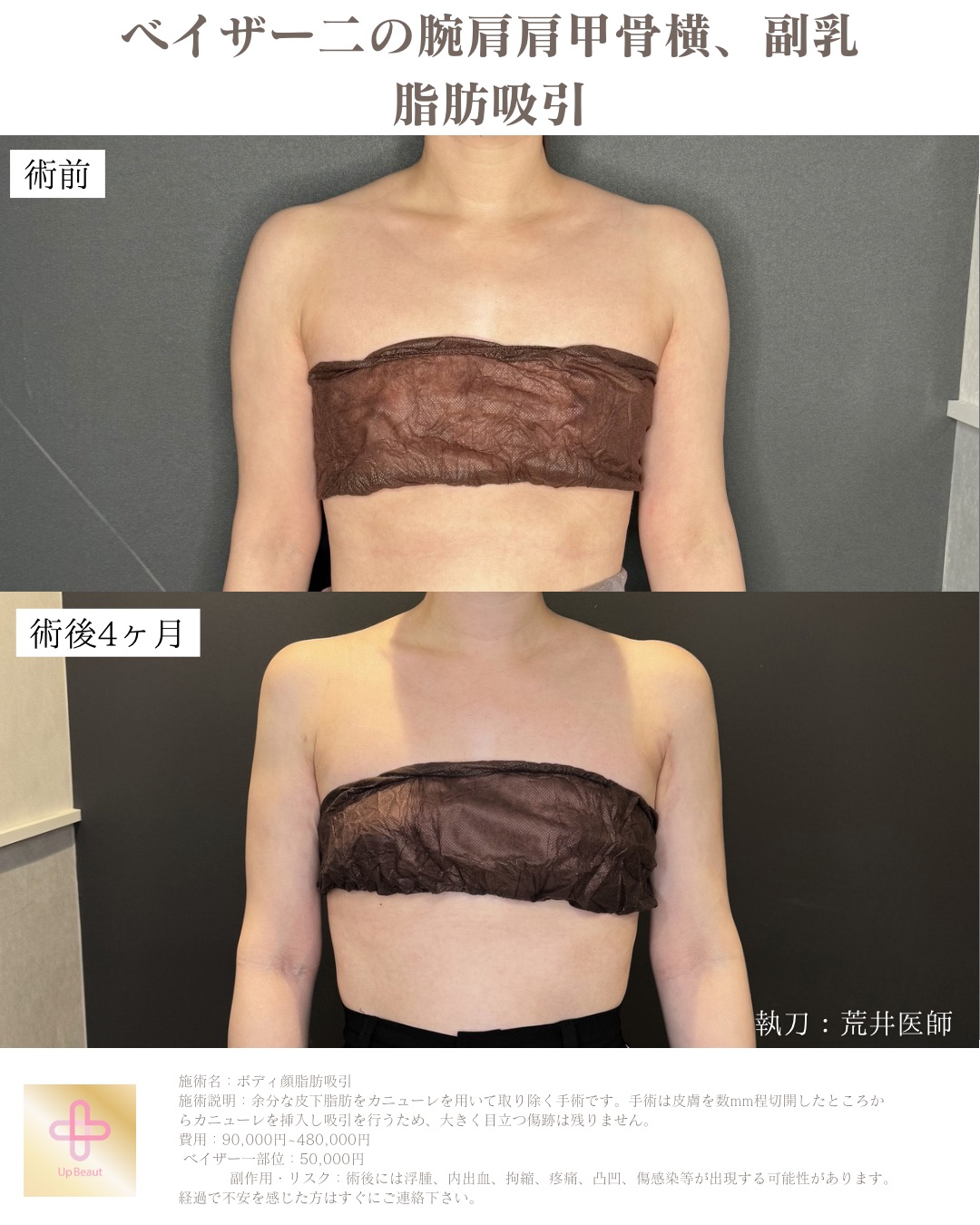 二の腕肩肩甲骨横、副乳脂肪吸引