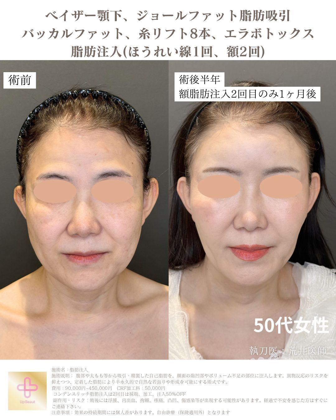 顎下のみ脂肪吸引、ジョールファット、バッカルファット、糸リフト８本、エラボトックス、脂肪注入(ほうれい線１回、額２回)