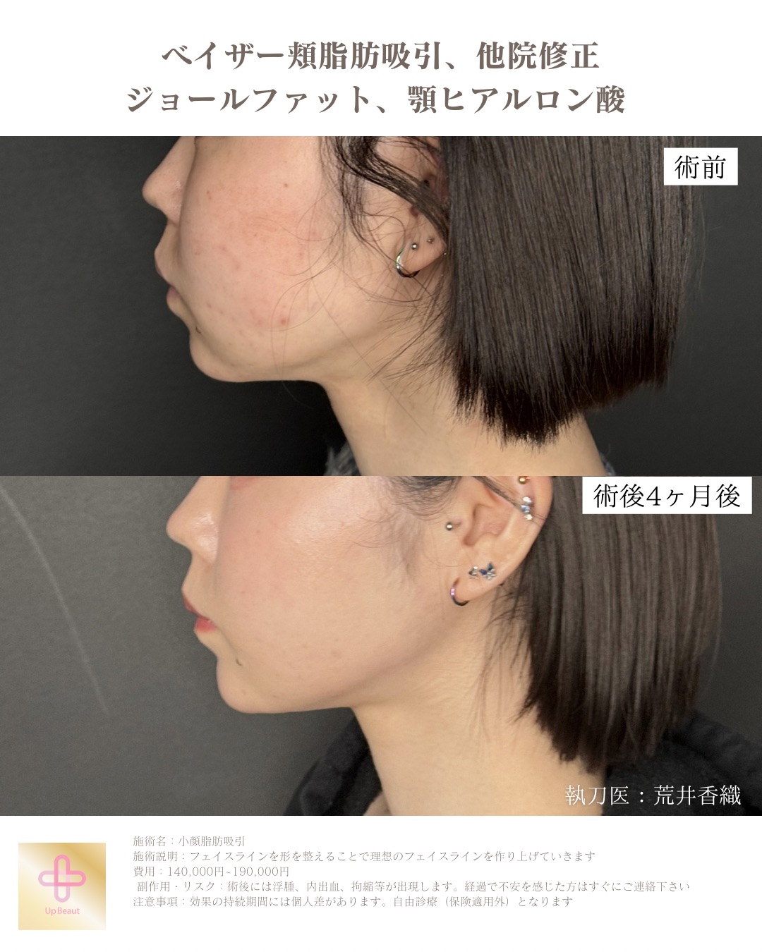 頬脂肪吸引、ジョールファット、顎ヒアルロン酸、他院修正