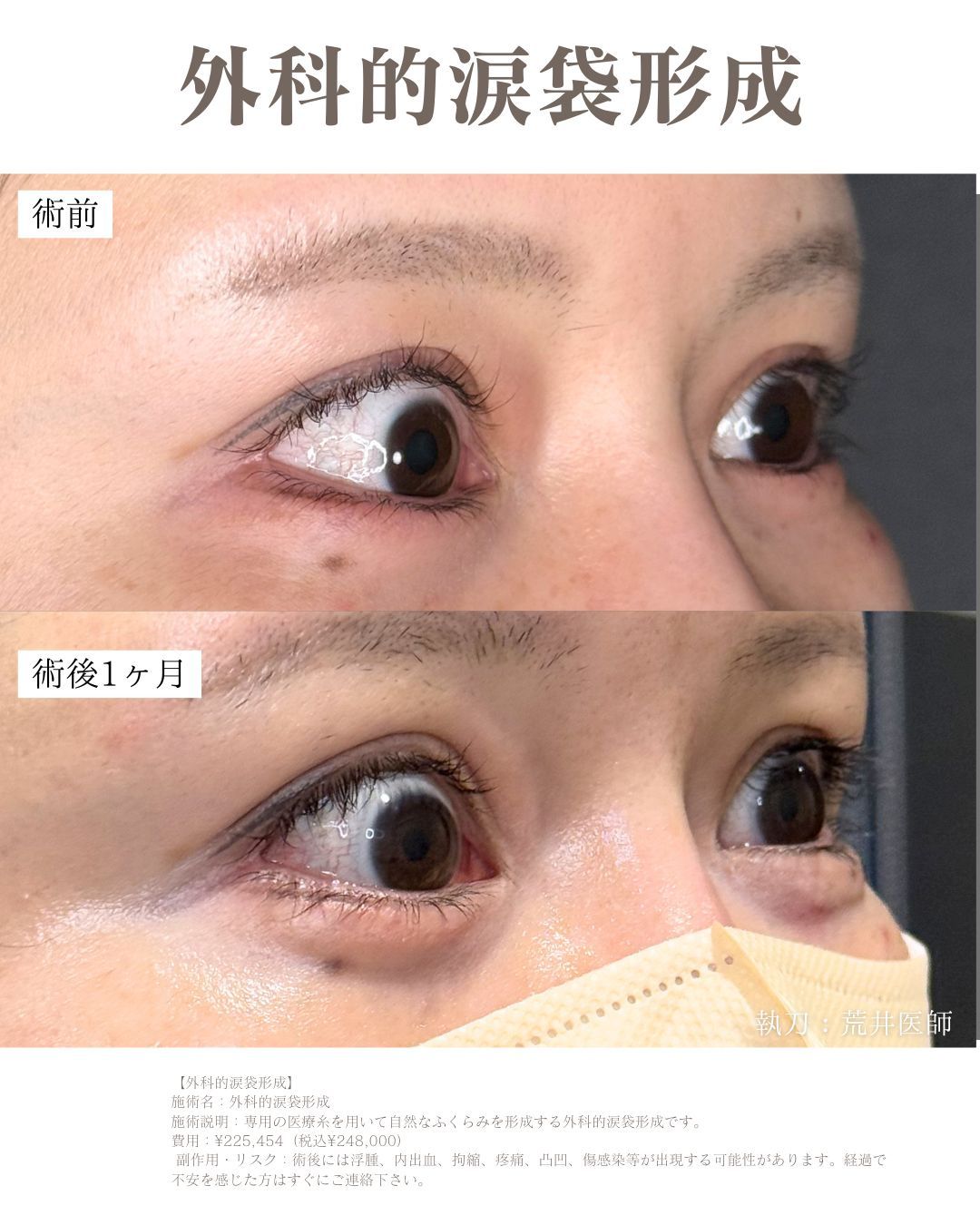 外科的涙袋形成