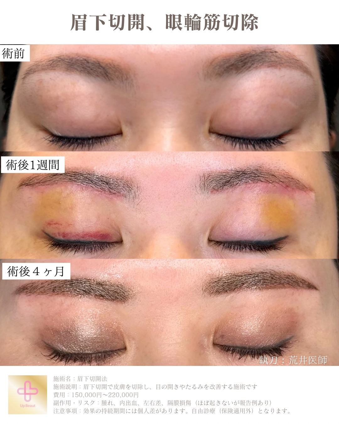 眉下切開、眼輪筋切除