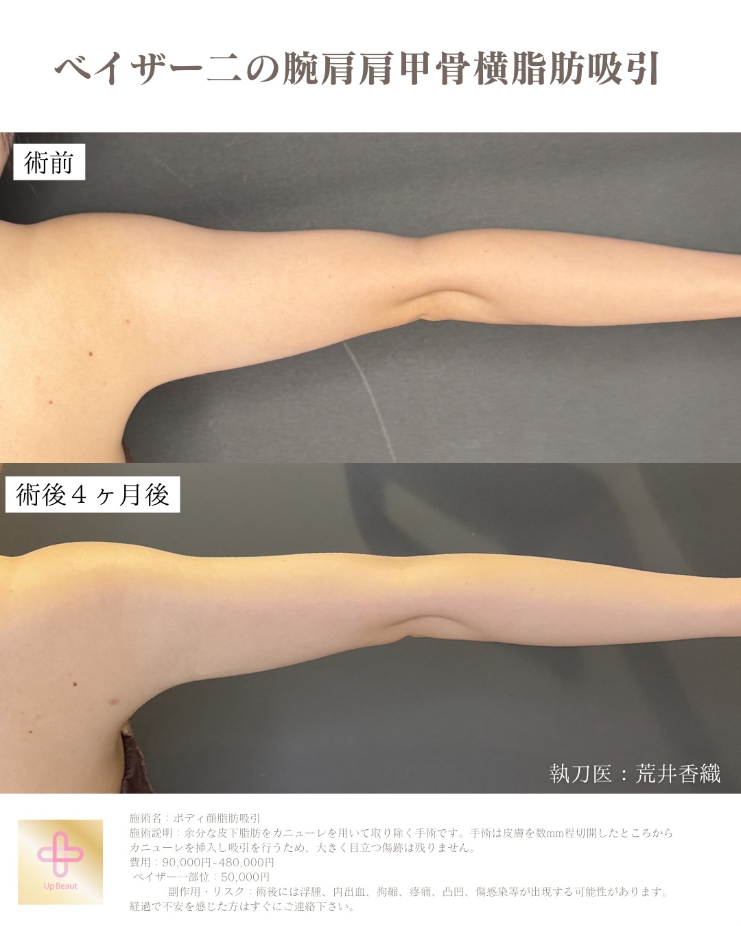 VASER脂肪吸引 引き締め症例1