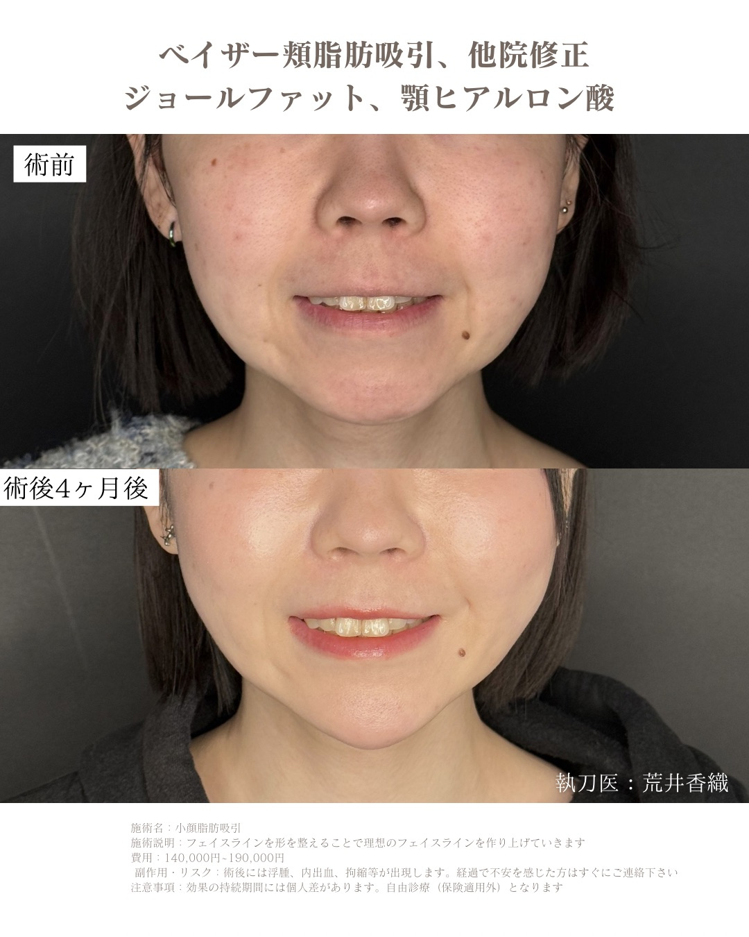 小顔脂肪吸引
