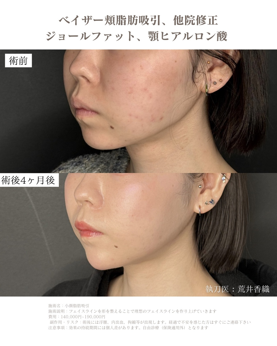 小顔脂肪吸引