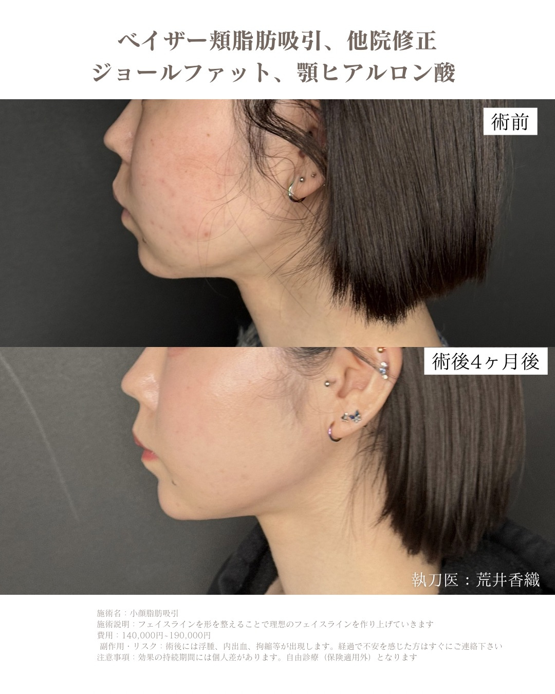 小顔脂肪吸引